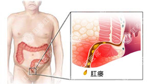 痔疮是什么样的