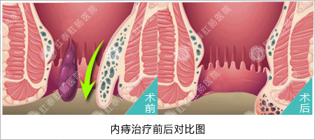 内痔脱出是什么原因