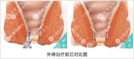 外痔疮的症状
